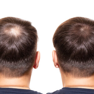 Men's Hair Restoration